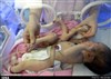 تصویر عمل جراحی روی نوزادِ «8 دست‌وپایی» + عکس