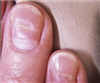 تصویر ناخن‌های کوویدی: تغییراتی در ناخن‌ که ممکن است بیانگر عفونت کووید باشد
