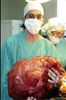 تصویر جراحان تومور 50 سانتی‌متری را از بدن یک آرژانتینی خارج کردند.